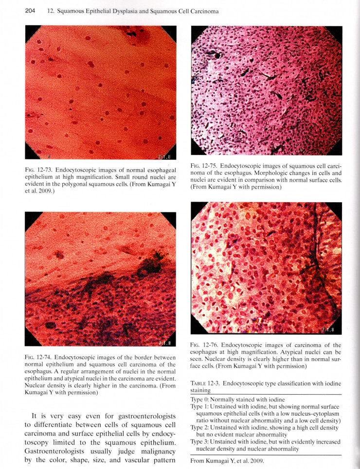 エンドサイトで見た食道上皮Pathology of the Esophagus, 3rd ed Wiley2017p204 左上正常食道上皮細胞右上癌細胞左下正常癌移行部右下癌細胞