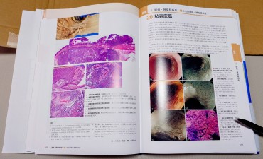 食道原発の粘表皮がんを埼玉医科大学の熊谷洋一教授が担当